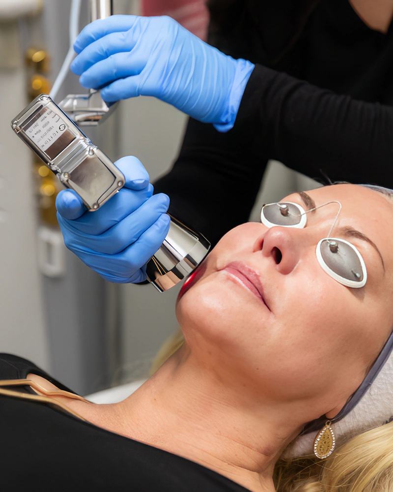 Pourquoi choisir le MicroLaserPeel
